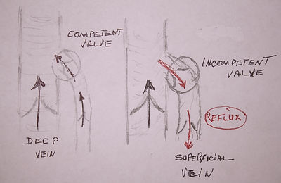 normal and pathological flow in leg veins