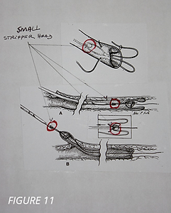 vein removal hook technique