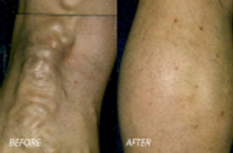 variciose_veins81-150x100.png