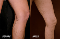 variciose_veins101-150x100.png