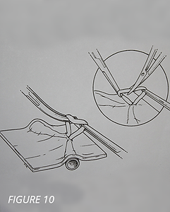 vein removal hook technique