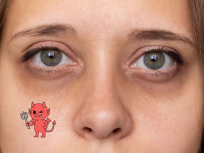 Frau mit Augenringen