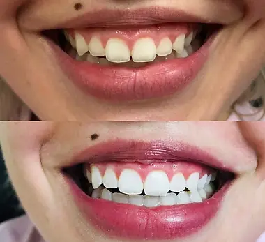 Teeth+Whitening+Before+After+(4).webp