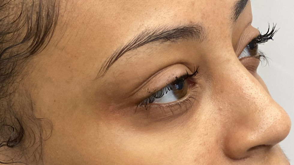 After under eye filler