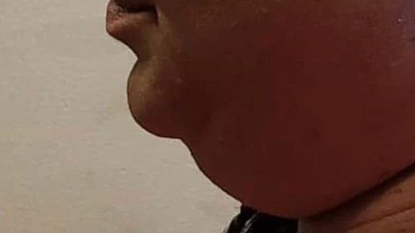 Before Kybella treatment