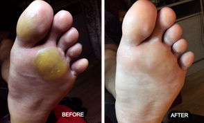 callus-before-and-after-bn-treatment_edited.png