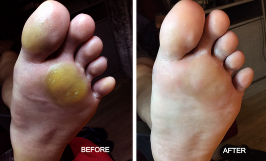 Callus Before and After BN Treatment_edited.png