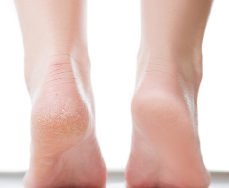 callus treatment blog (2)_edited.png