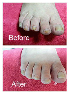 Nails Fungus (Before and After Treatment).jpg