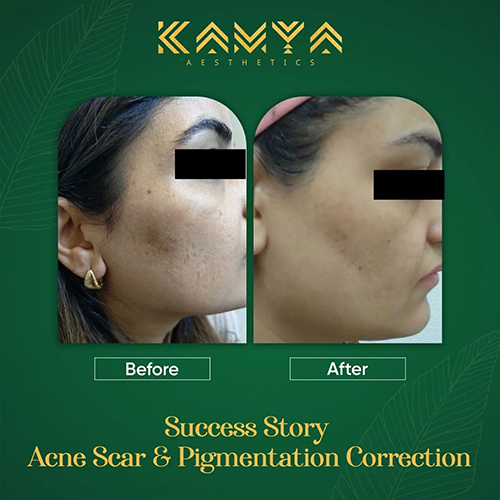 Before-and-after images of acne scar treatment on a woman's face, with a green background and text reading Kamya Aesthetics, Success Story.
