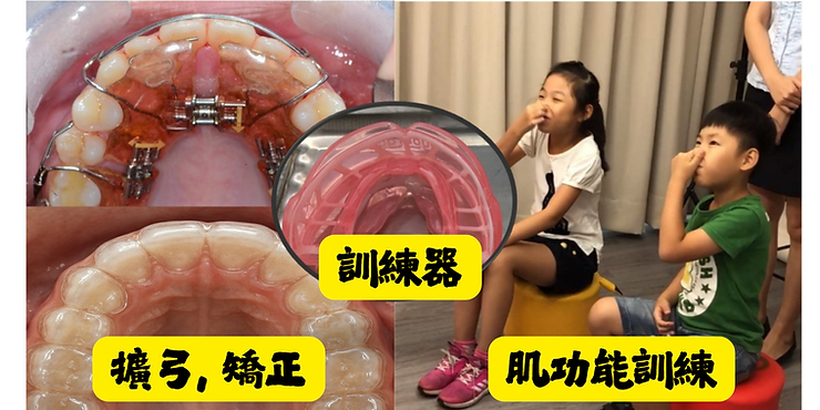 孩子又磨牙?兒牙專科侯侯醫師:原因不純是壓力大! 孩子又磨牙?兒牙專科侯侯醫師:原因不純是壓力大!