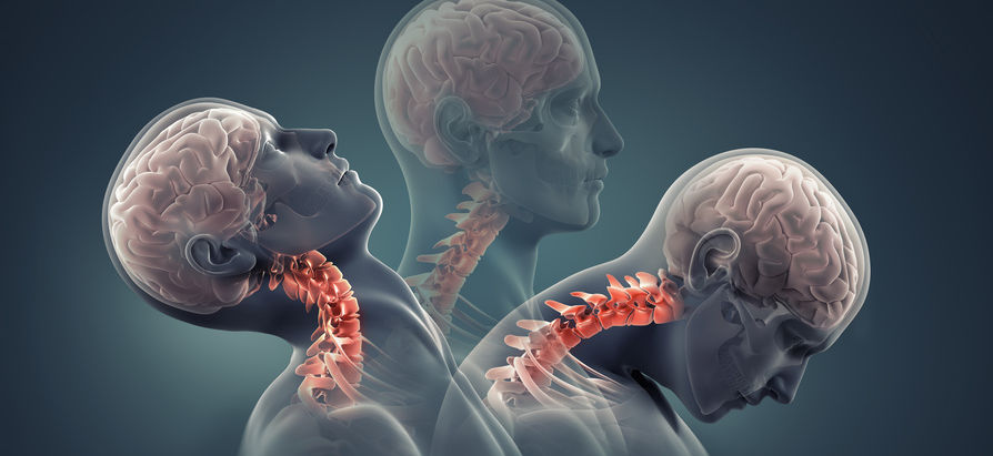 Prédire les conséquences à long terme d'un accident de voiture avec traumatisme cervical - Whiplash