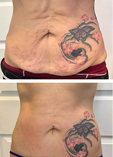 stomach-flattening-aplanamiento-de-abdomen-before-after-irving-100beautymd.jpg