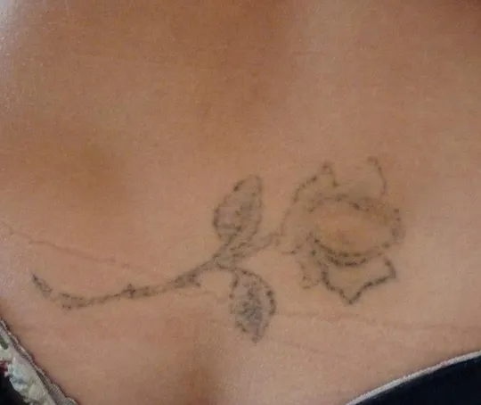 Laser Tattoo Removal Sandhurstclinic