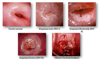 Cáncer de Cuello Uterino