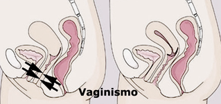 Miedo y Dolor en la Relación Sexual