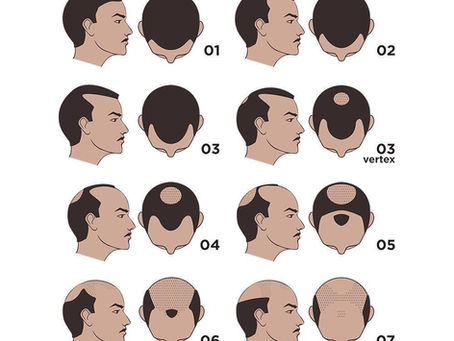 Is Scalp Micropigmentation Right for You?