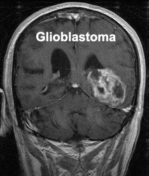 glioblastoma