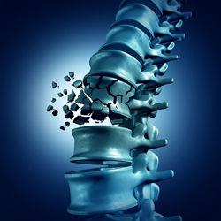 FRACTURA VERTEBRAL