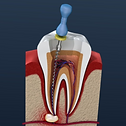 root-canal-illustration-2-1024x672_edited.png