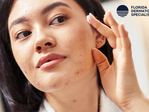 What Are The Best Treatments For Severe Acne?