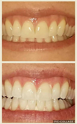 teeth whitening