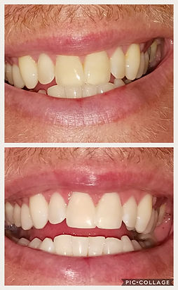 teeth whitening