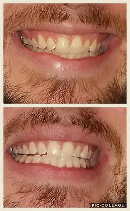 teeth whitening