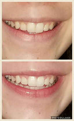 teeth whitening