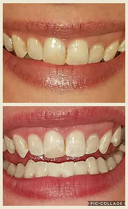 teeth whitening