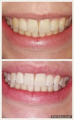 Before And After Pictures Tallahassee Smilelabs Teeth Whitening