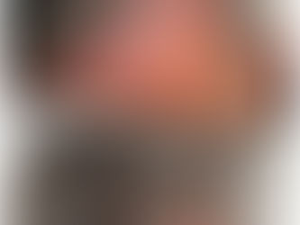 SMP vs Wigs & Hair Fibres: Why scalp Micropigmentation Wins Long-Term