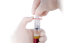Platelet Rich Plasma Cell Treatment