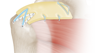 Avoid Reverse Shoulder Replacement!