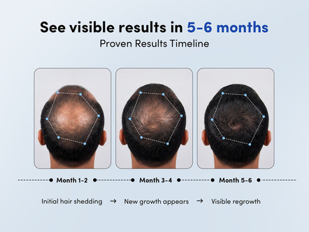 When Will You See Results in Hair Loss Treatment? A Realistic Timeline
