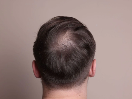 How to Improve PRP Results in Your Clinic: A Practical Guide for Better Outcomes