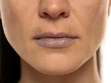 Why Do Lips Lose Their Colour? A Clinical Look at Lip Pigmentation and the Case for Hydration-First Skin Boosters