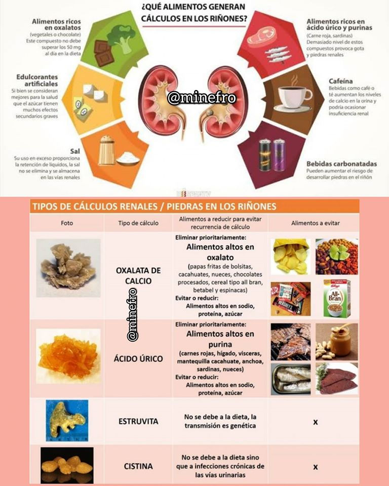 LITIASIS RENAL (PIEDRAS EN RIÑON)