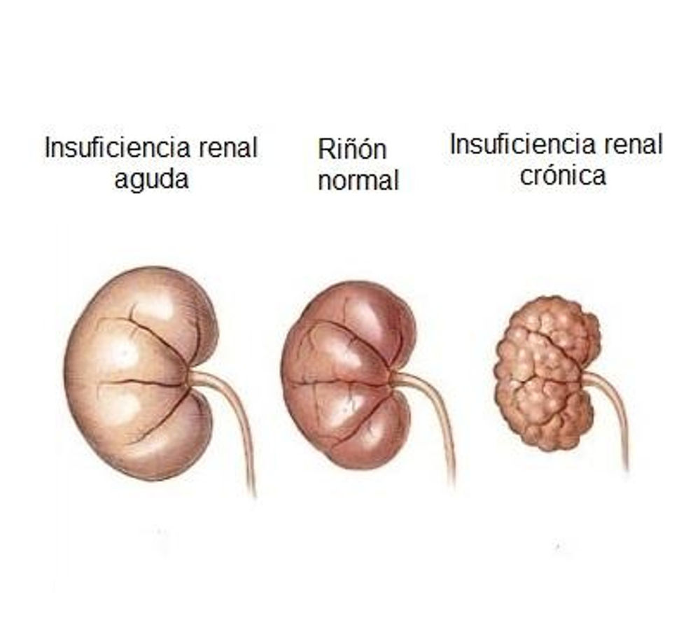 ENFERMEDAD RENAL CRÓNICA. MAS VALE PREVENIR QUE DIALIZAR, ACUDE AL ...