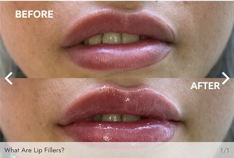What Are Lip Fillers