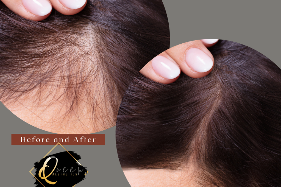 How Long Does PRP Hair Treatment Last? Duration Benefits