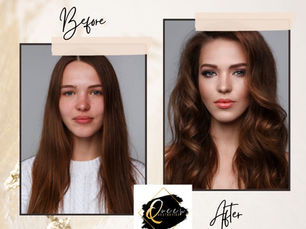 What is Facial Balancing with Fillers Before and After?