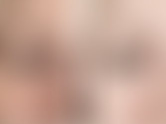 20 Units of Botox Before and After: What to Expect