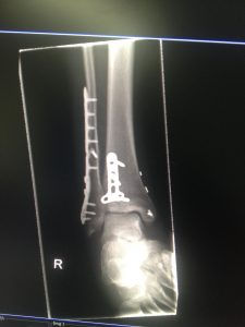 How the addition of Gold led to a new harder Titanium alloy with potential for use in implants