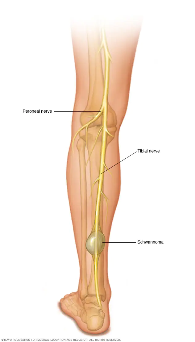 schwannoma-in-the-leg-8col.webp
