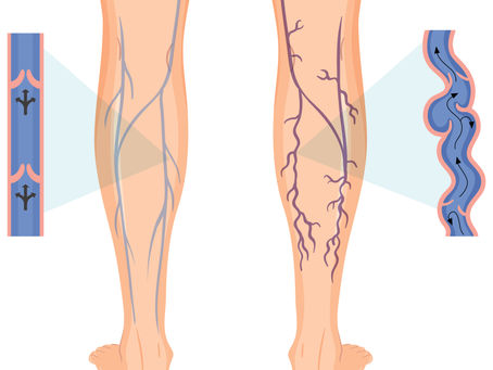 6 Unknown Dangers of Varicose Veins if Left Untreated