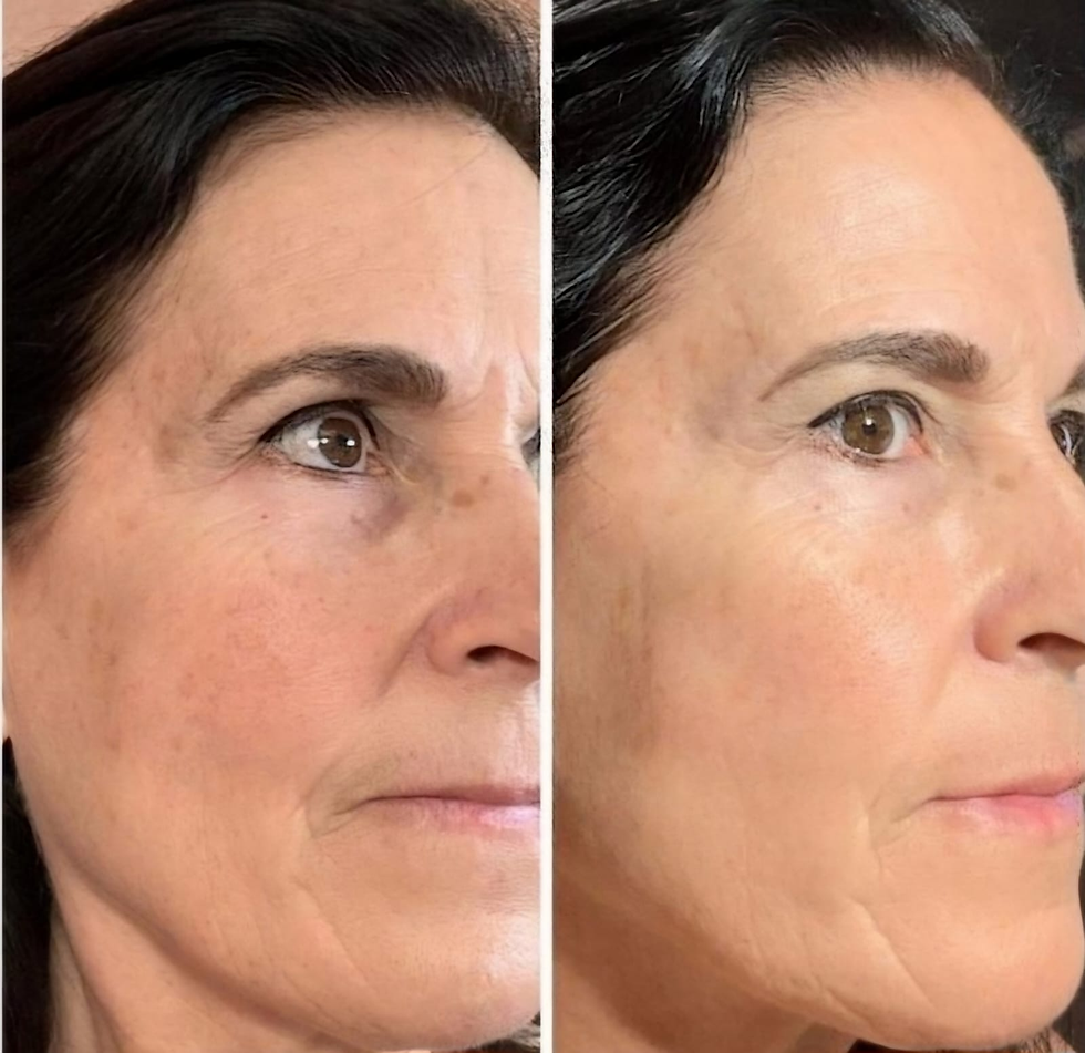 לפני ואחרי טיפול פוטוביודינמית צילום יחצ