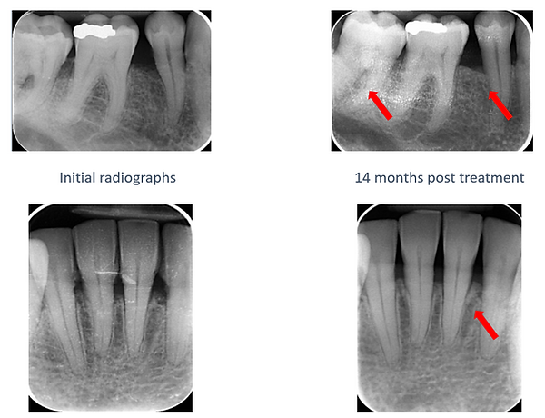 Perio- before and after laser tx John.PNG
