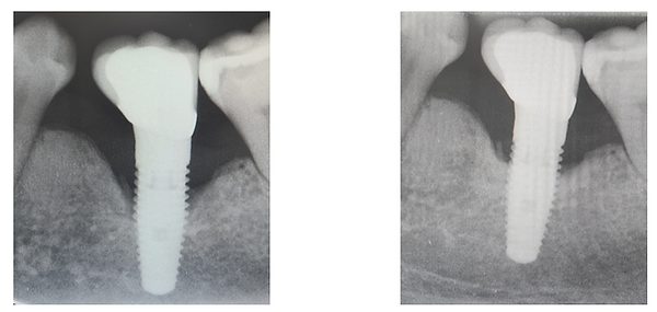 Peri-implantitis before and After laser tx (13 months after).PNG