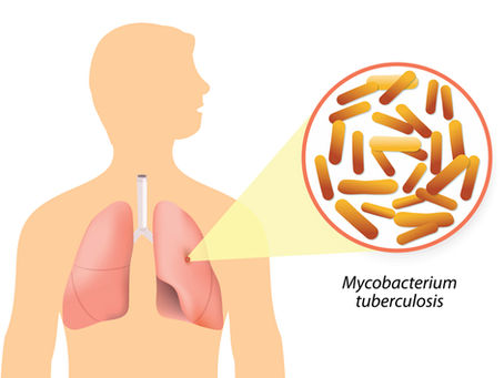 TB situation needs increasing accessibility of affordable, quality, effective and safe drugs, vaccin